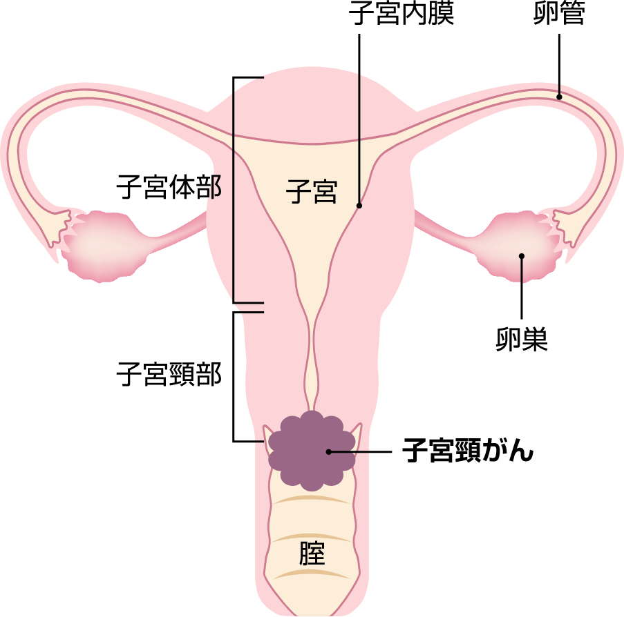 子宮頸がん