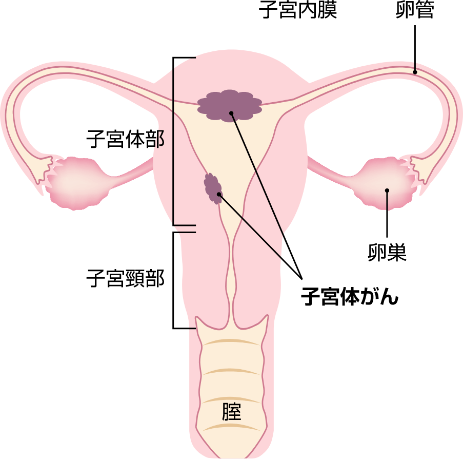 子宮体がん