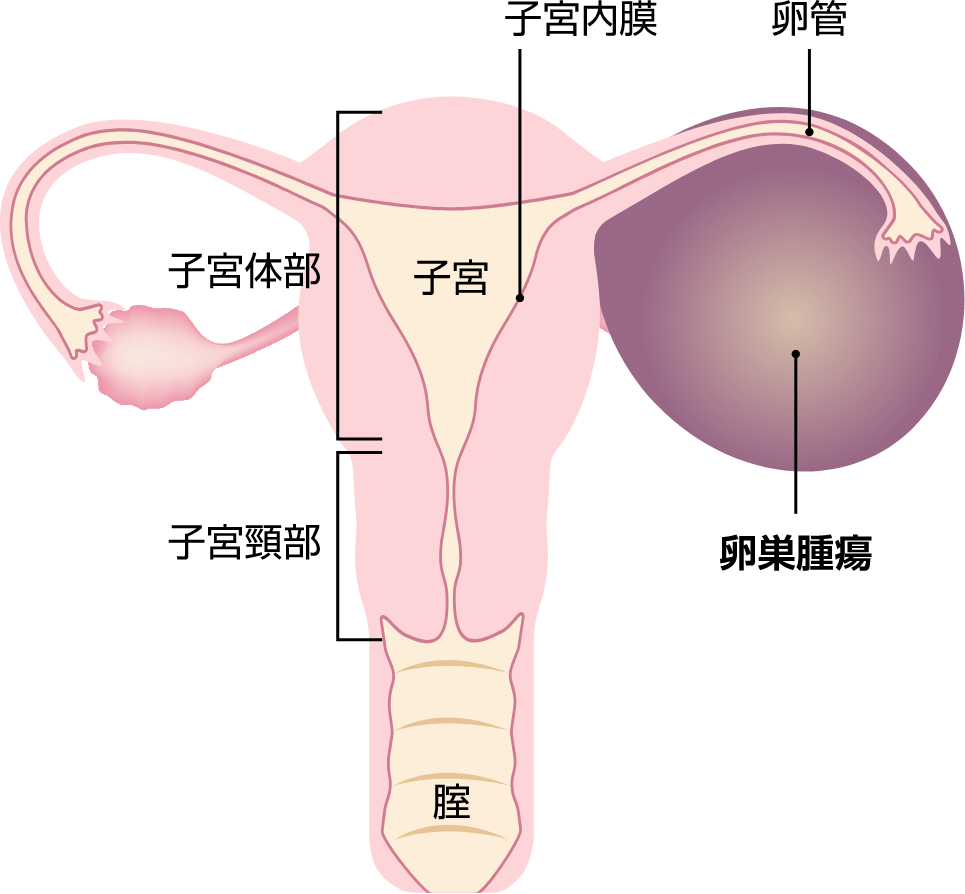 卵巣がん